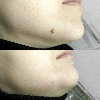 Before and after use Skincell Pro