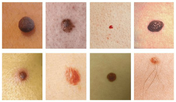The most common skin spots is nevus and papilloma (warts)