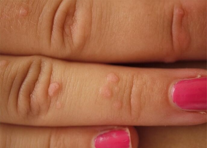 warts on hands