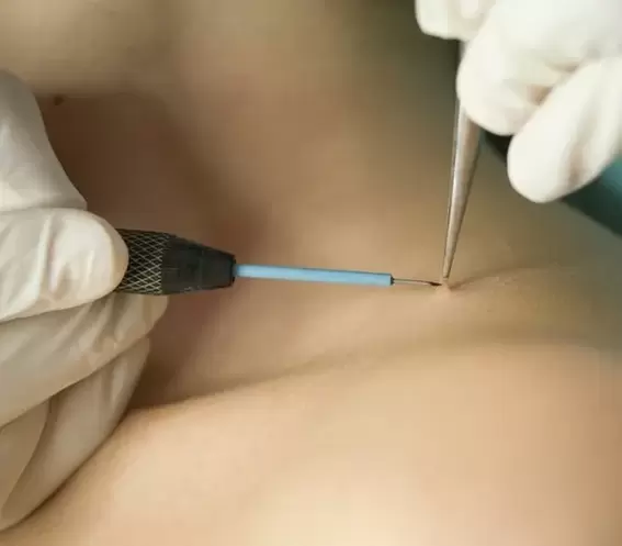 Papilloma removal by electrocoagulation
