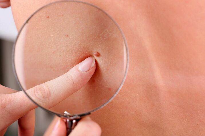 how to remove warts on the face