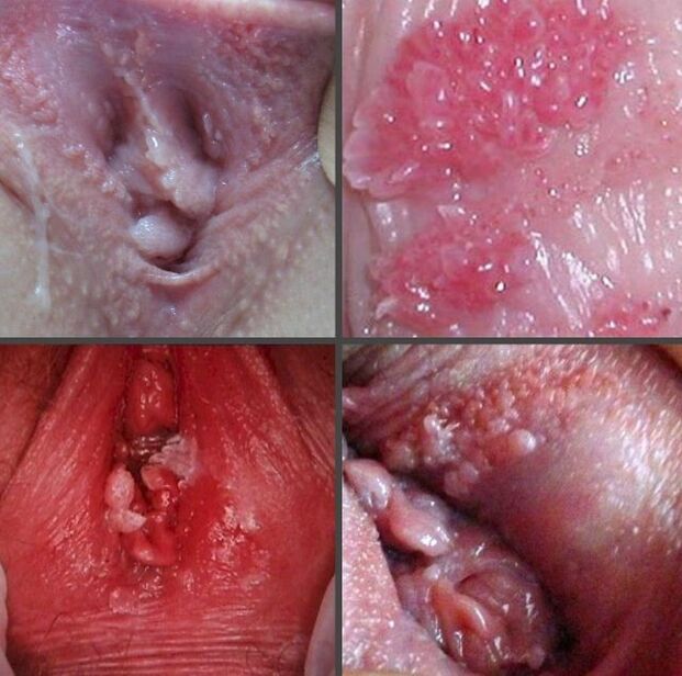 Close to a papilloma in the vagina