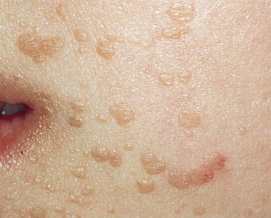 flat warts on the face