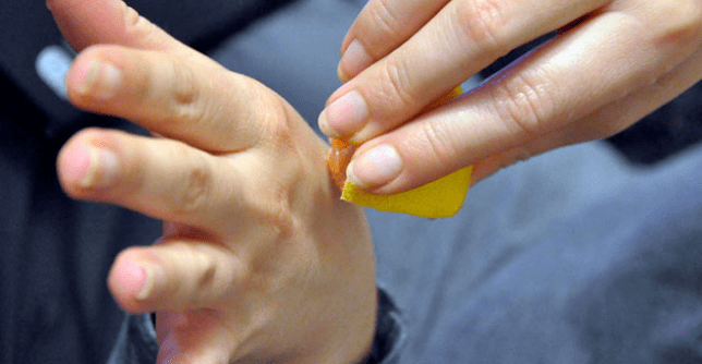 removal of the wart on the hand