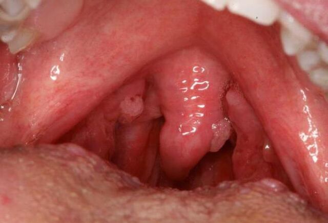 papilloma of the throat