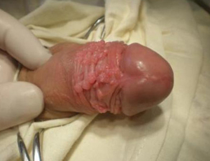 Papilloma of the penis