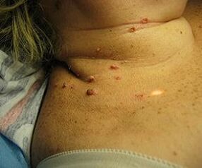 human papilloma virus on the neck