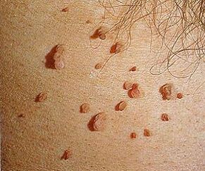 human papilloma virus on the skin