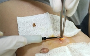 surgical treatment of human papilloma virus
