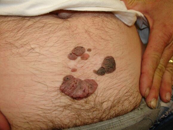 papilloma on the abdomen of a man