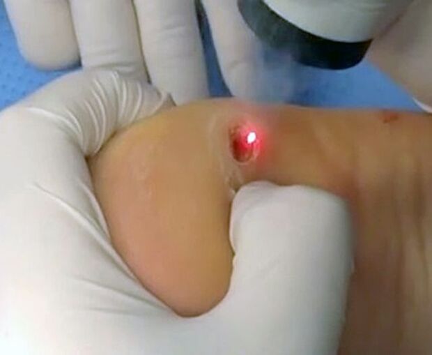 Procedure for removing warts on the heel with a laser