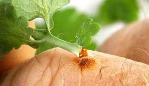 how to remove a wart with celandine