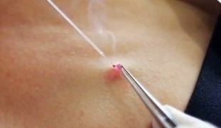 laser papilloma removal on the body
