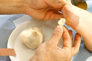 Treatment of papilloma with garlic dressing